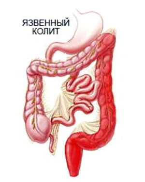 язвенный колит