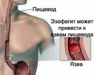 патология пищевода при рефлюксной болезни