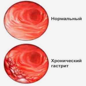 Хронический гастрит