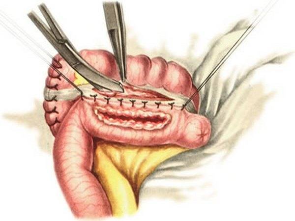 гемиколэктомия