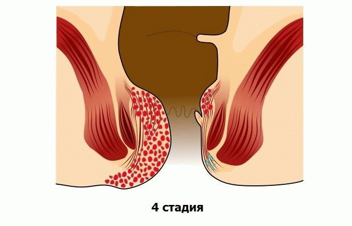 Четвертая стадия геморроя
