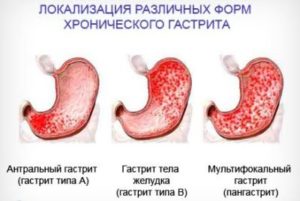 классификация гастритов