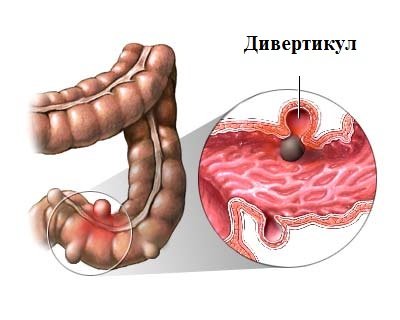 каловые камни в кишечнике