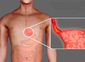 Изжога: причины