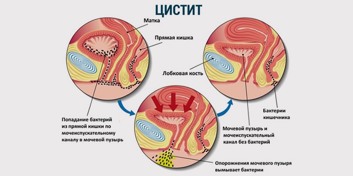 цистит