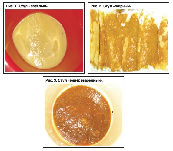 Виды кала при поносе