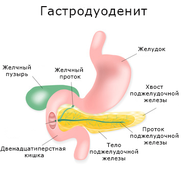 Гастродуоденит