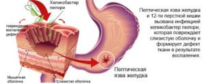 хеликобактериоз