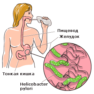 Заражение Helicobacter pylori