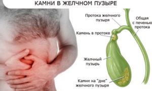 наличие камней в жёлчном пузыре