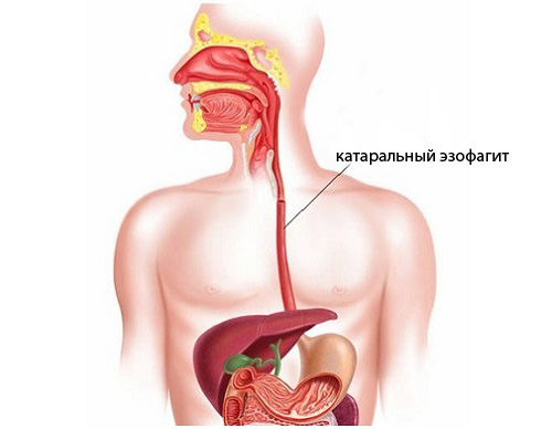 эзофагит катаральный