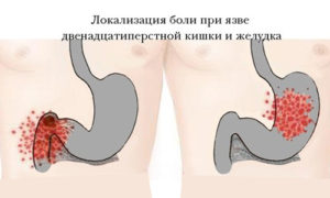 локализация болей