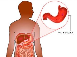 рак желудка