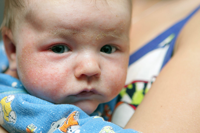 Аллергические реакции