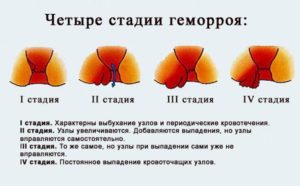стадии геморроя