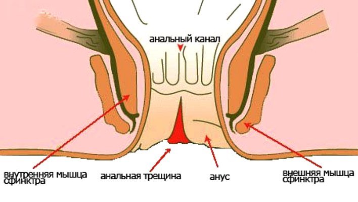 анальная трещина