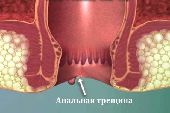 при анальной трещине не рекомендуется делать содовые клизмы