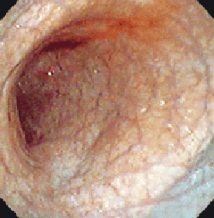 антральная атрофия желудка