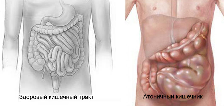 атония кишечника