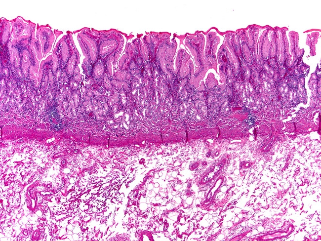 Хроническая форма атрофического гастрита