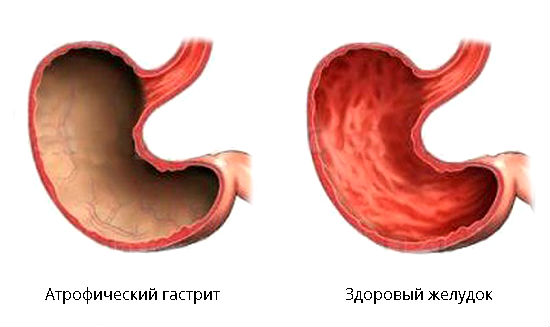 Атрофический гастрит