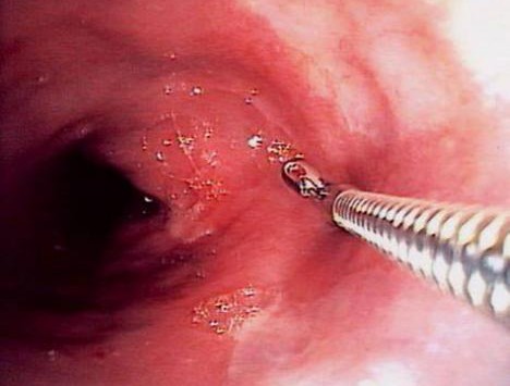 биопсия при гастроскопии