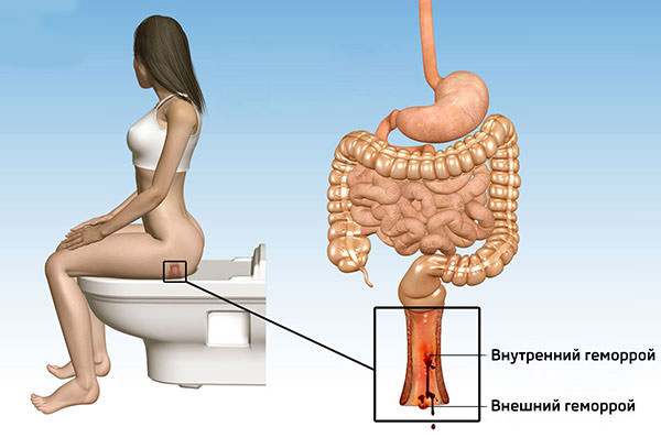 Боль в заднем проходе из-за геморроя