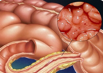 болезнь Крона