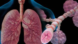 бронхоспазм