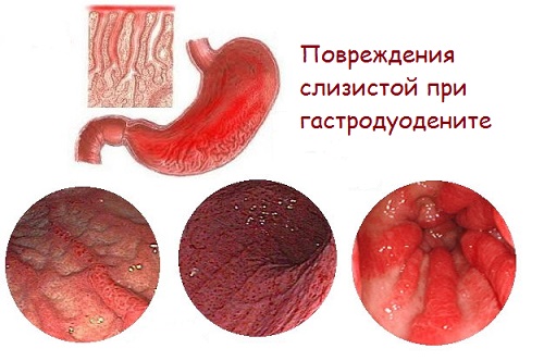 Гастродуоденит