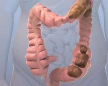 нарушение формирования и продвижения стула