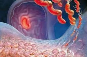 эрозивный гастрит из-за хеликобактер пилори