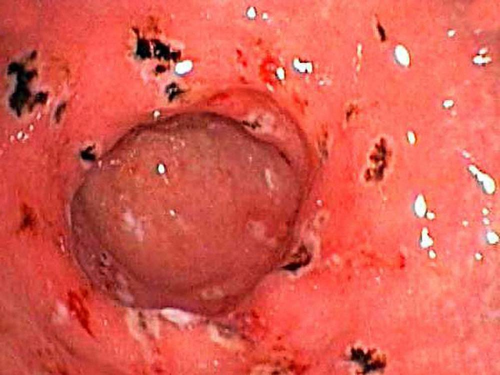 эрозивный гастрит