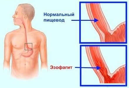 эзофагит