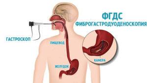 фиброгастродуоденоскопия