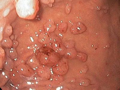 гастрит зернистый