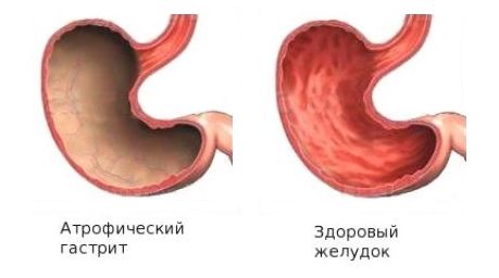 атрофический гастрит