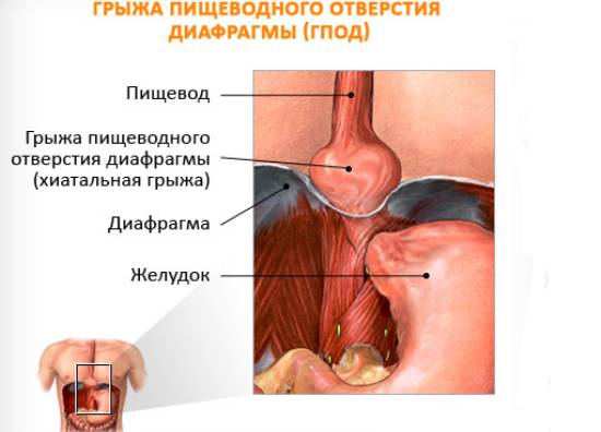 диафрагмальная грыжа