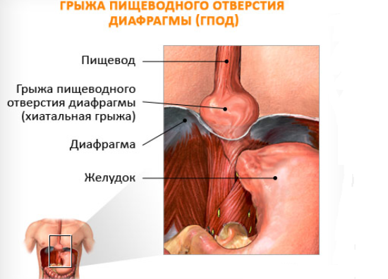 грыжа пищеводного отверстия диафрагмы