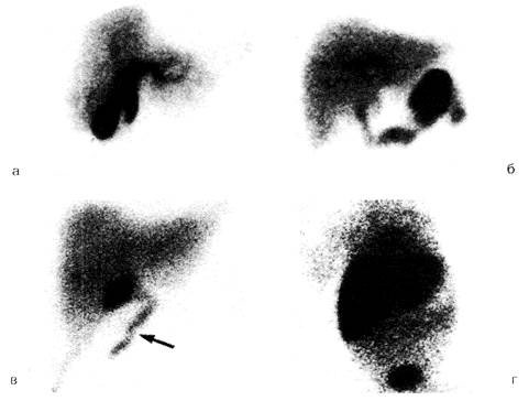 холецистинграфия