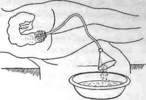 Методика проведения сифонной клизмы