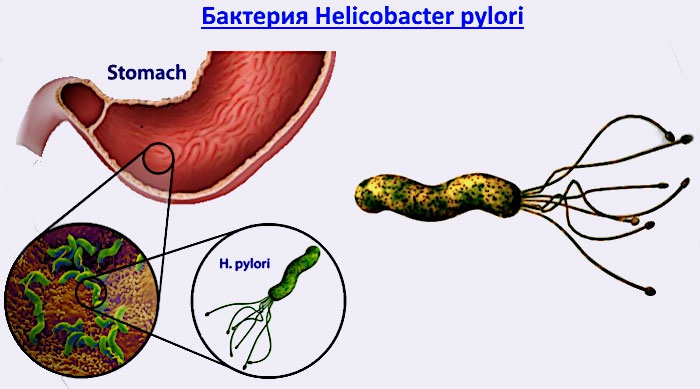 Helicobacter pylori