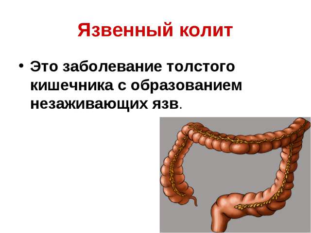 Язвенный колит