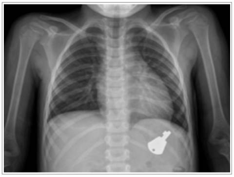 инородное тело в брюшной полости