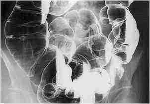 ирригоскопия