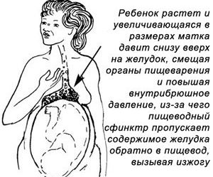 изжога на поздних сроках беременности