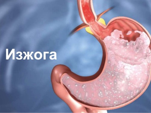 изжога