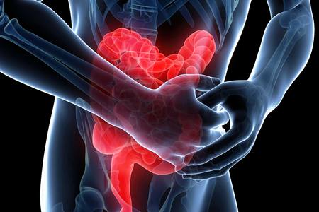 кишечная непроходимость