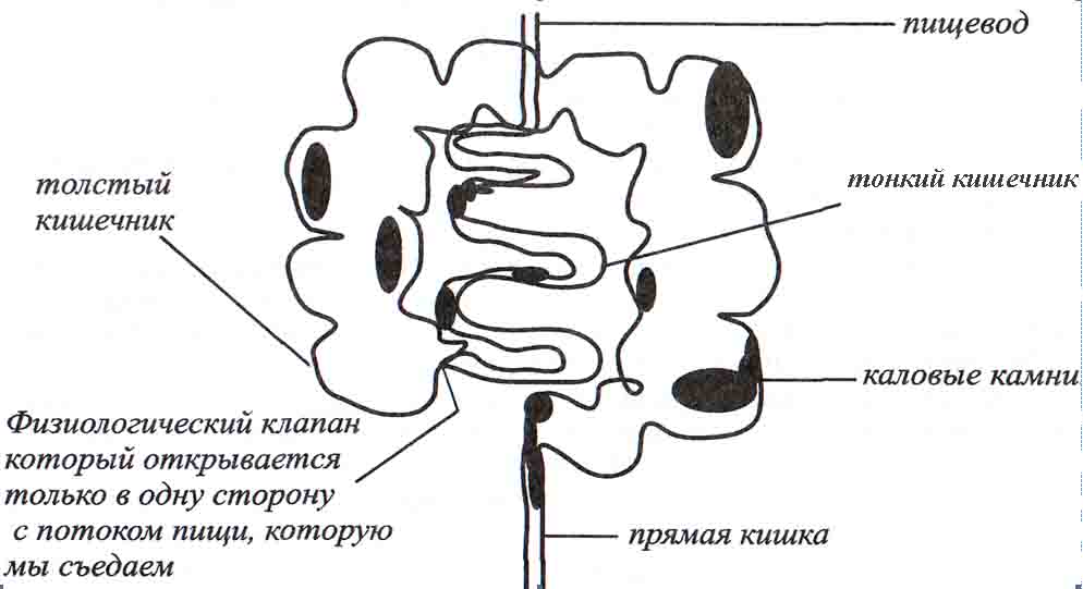 Каловые камни в кишечнике