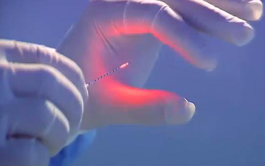 коагуляция лазером